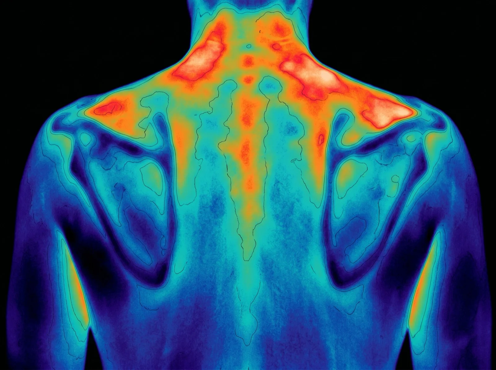 Kliniczny obraz termograficzny pleców — widoczny rozkład ciepła w okolicy karku i łopatek